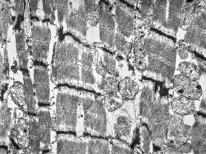 M,11y. | cardiomyopathy - left ventricle